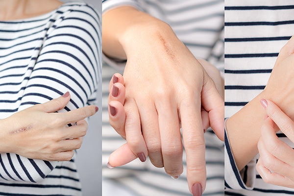 CBD Scar Treatment