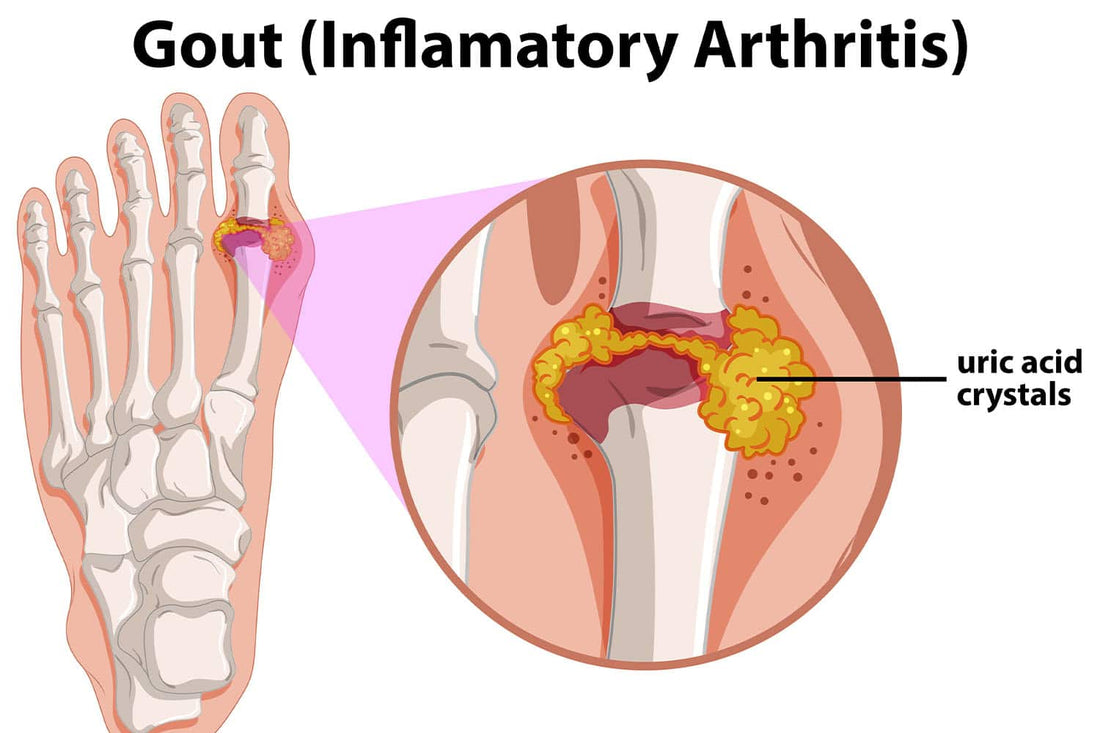 Gout